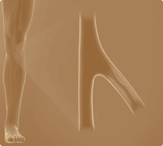 Medical illustration of a human leg with a close-up view of narrowed arteries, depicting peripheral artery disease (PAD) and restricted blood flow.