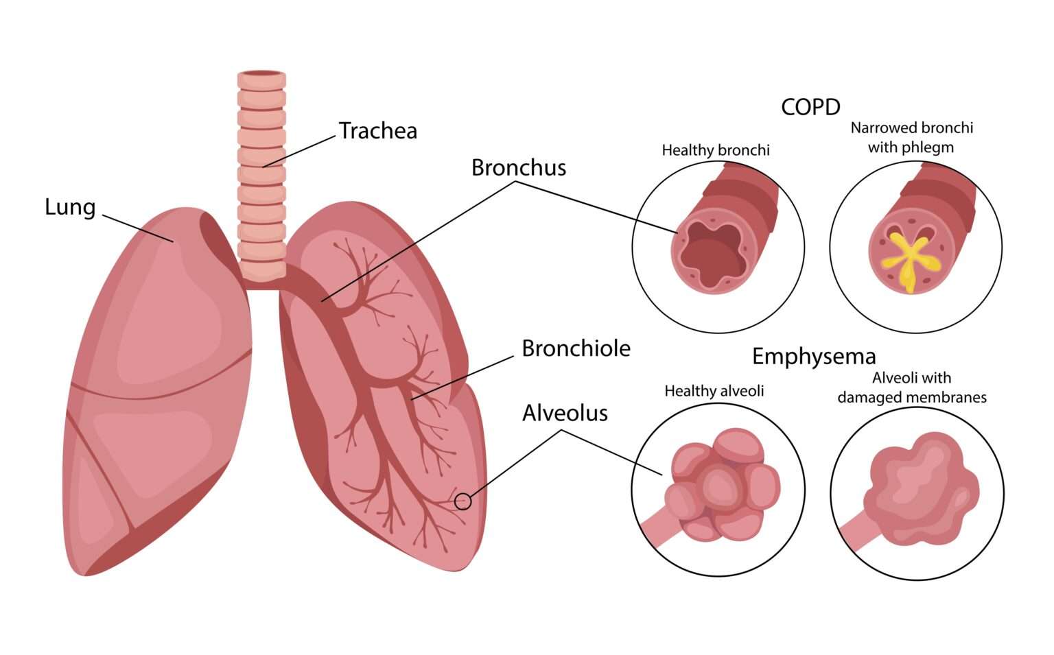 Understanding COPD & How Craft Body Scan Can Help