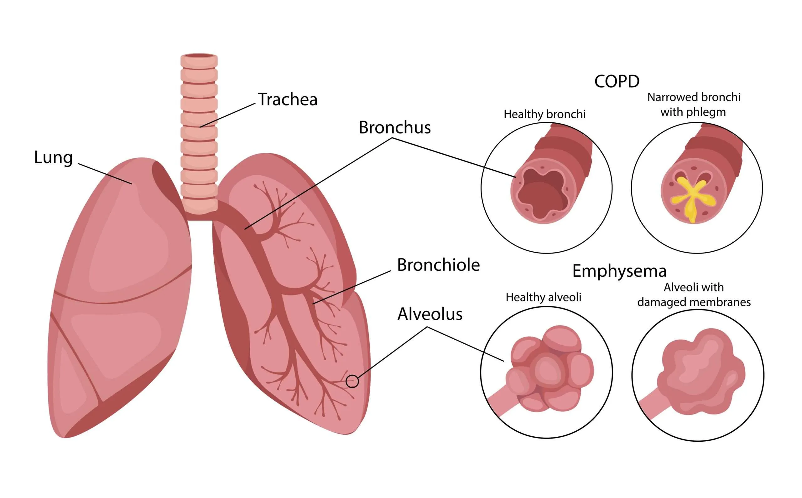 COPD