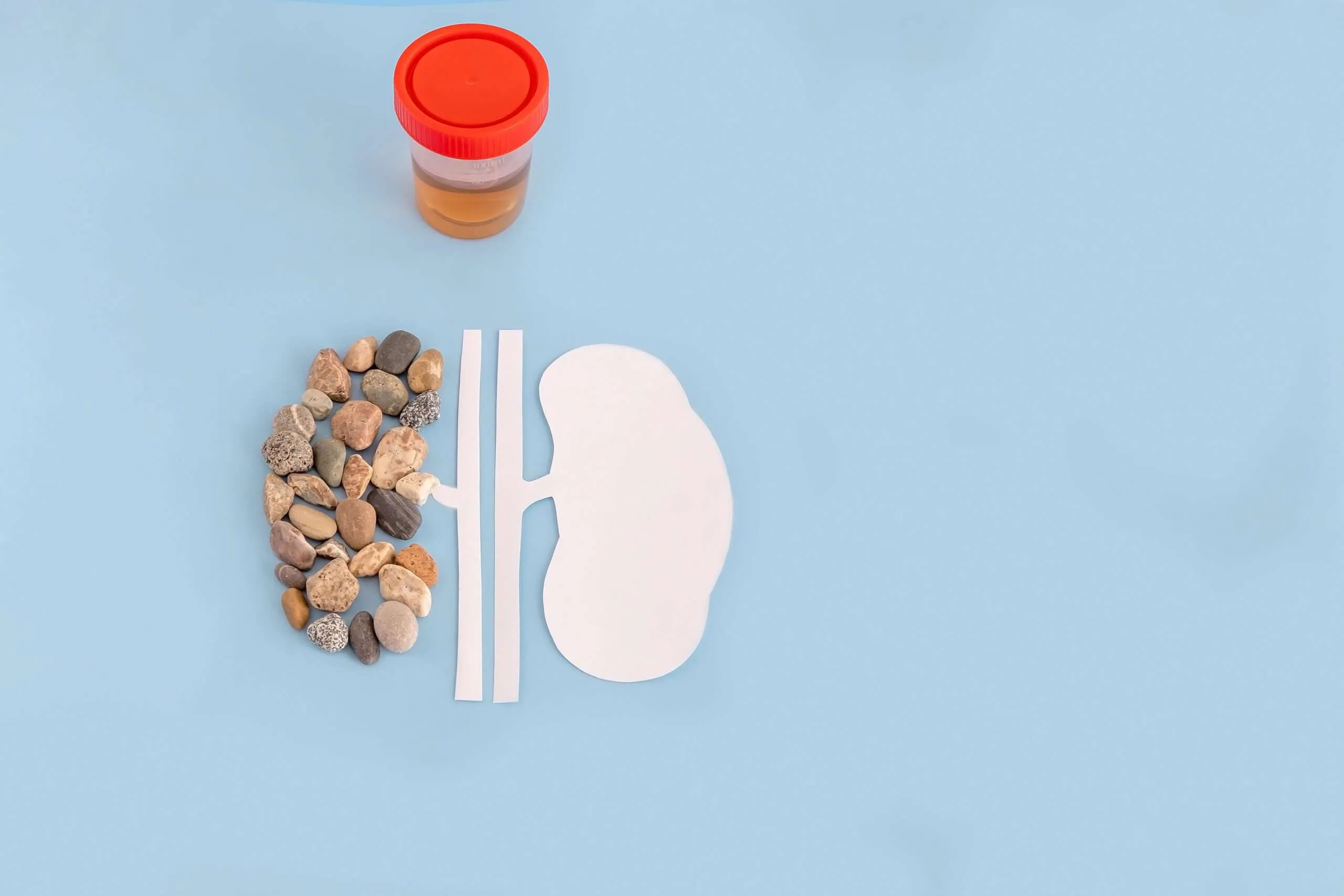 how to prevent kidney stones