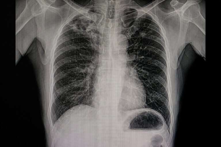 What are Pulmonary Nodules? | Craft Body Scan