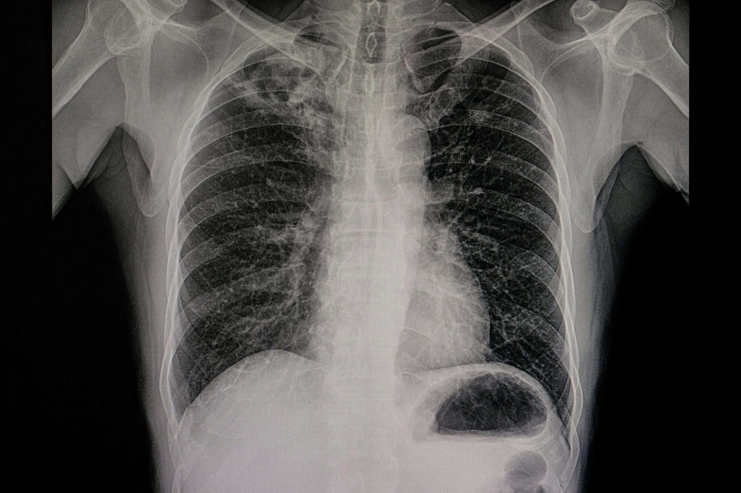 pulmonary nodules