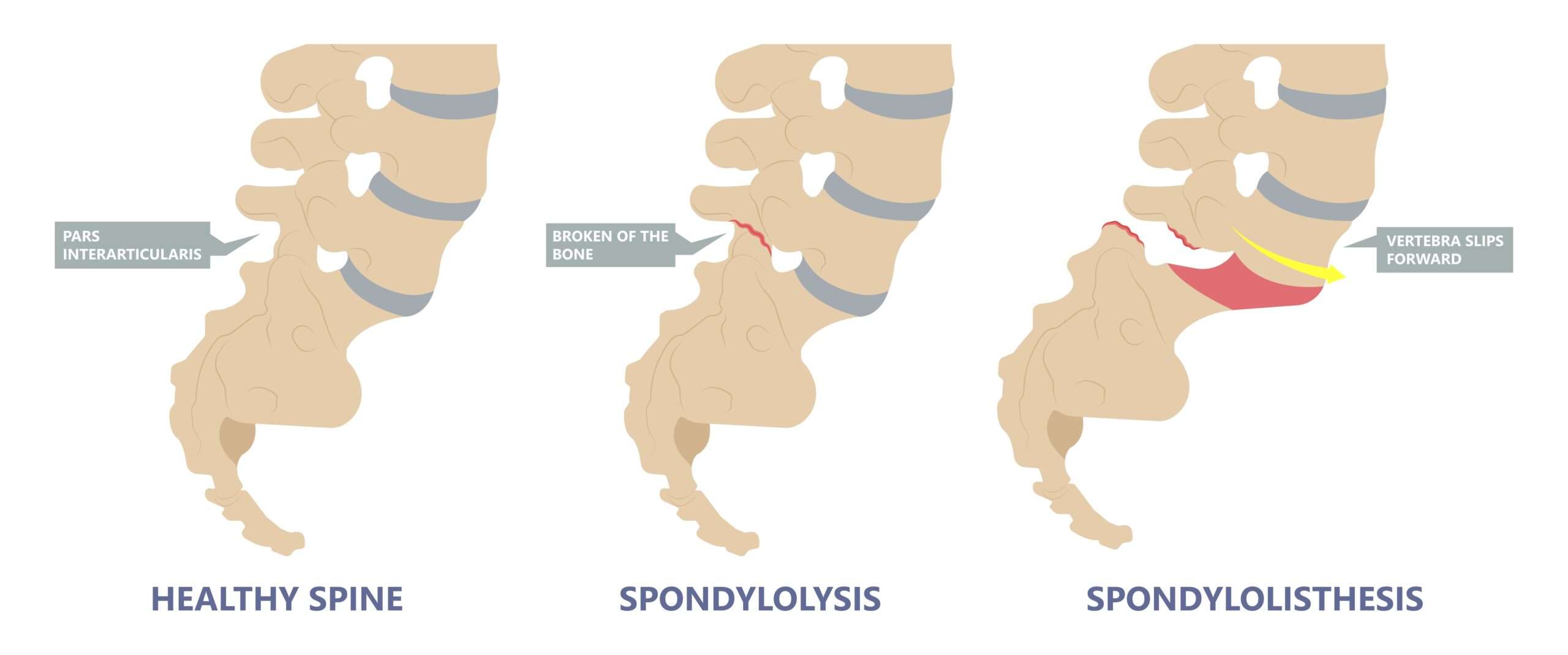 spondylosis symptoms