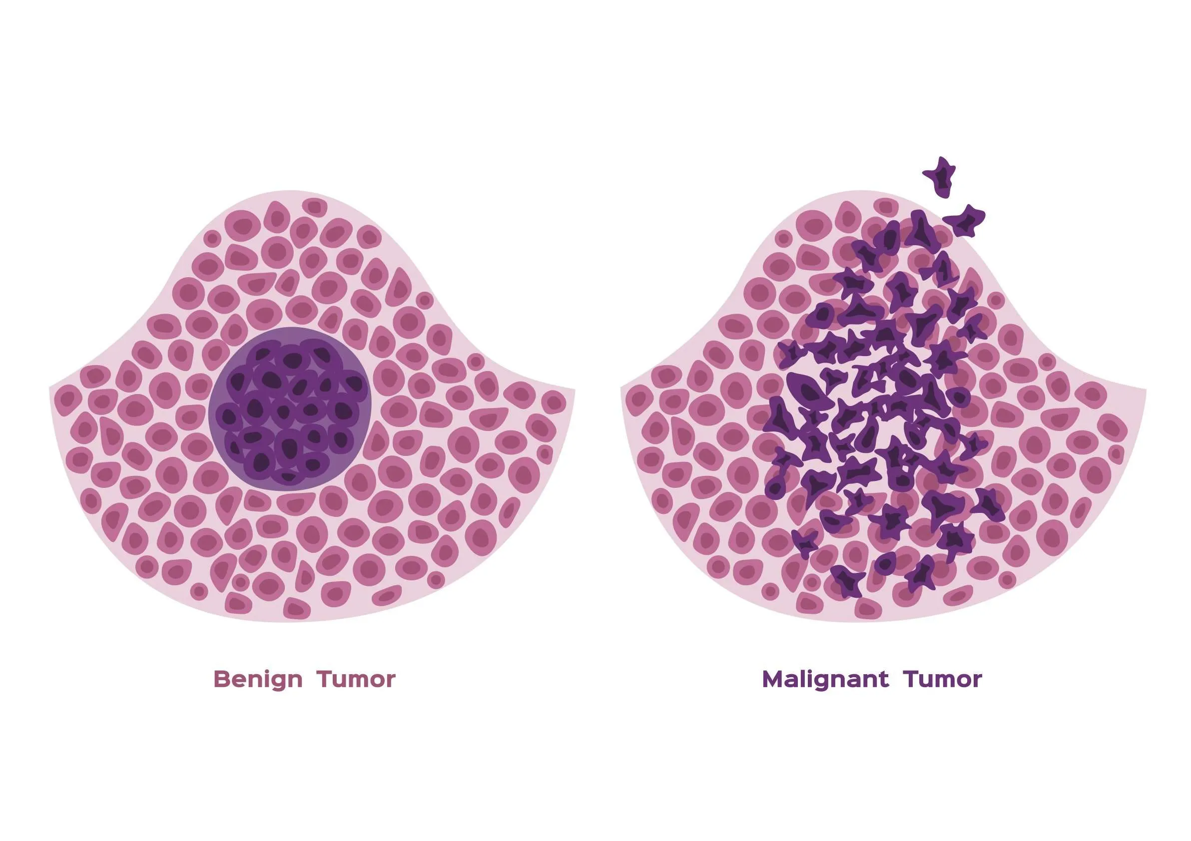 Two tissue sections, a smooth benign tumor inside normal tissue and jagged malignant cells breaking past the tissue edge