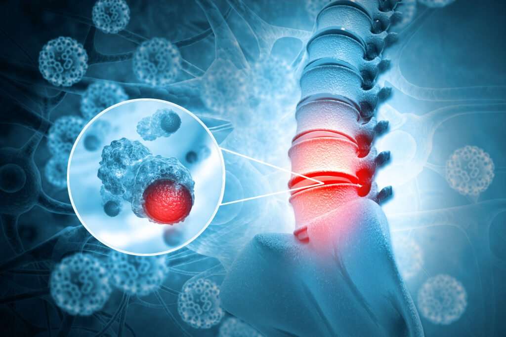 Difference Between a Benign and Malignant Tumor