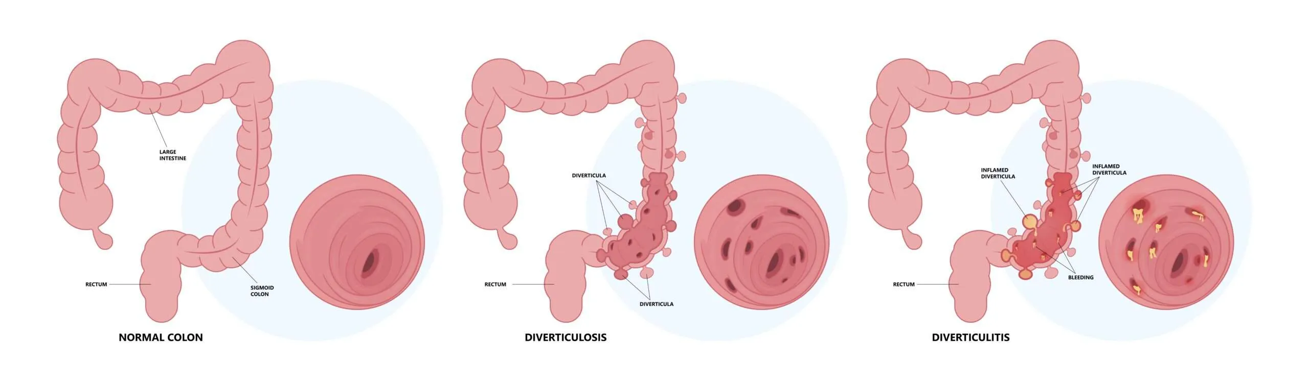 Diverticular Disease