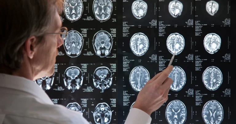 A medical professional examining a series of brain MRI scans displayed on a screen, pointing at specific areas to analyze neurological structures and potential abnormalities.